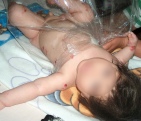Epidermolisis  Bullosa
