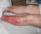 Psoriasis